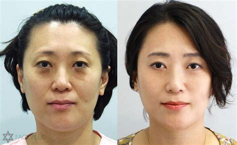 Face Plus Clinic Korea.